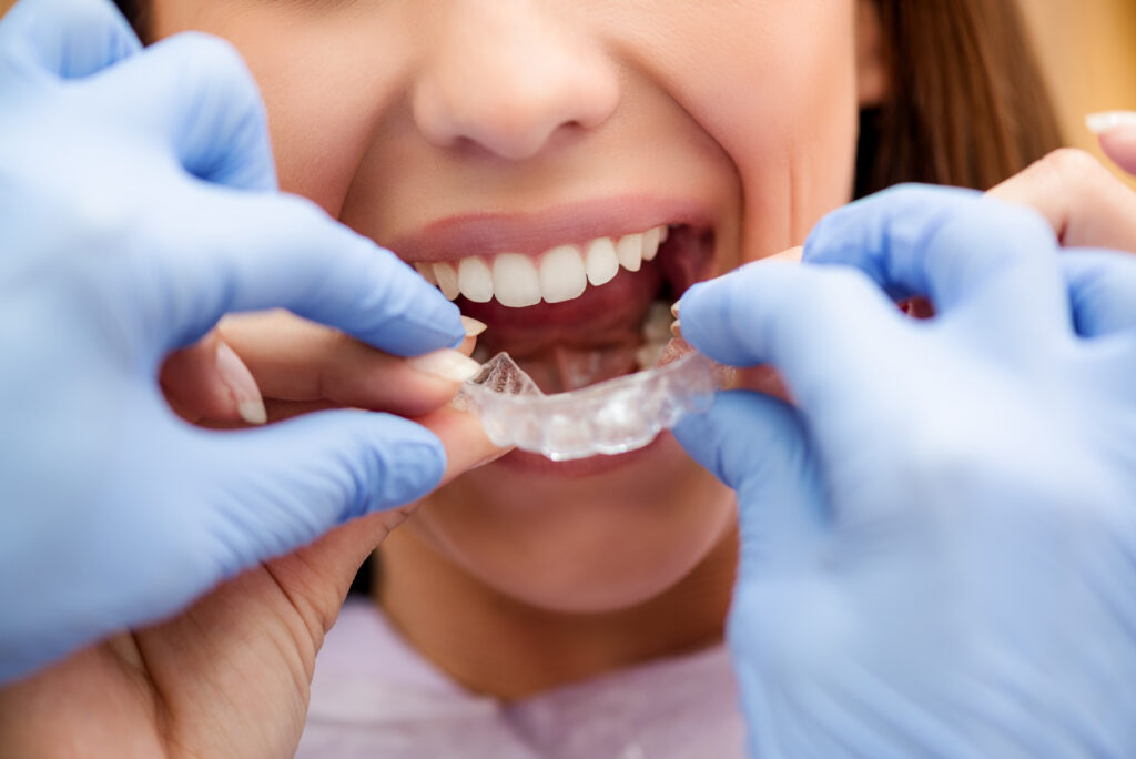 Price of Invisalign or Clear Aligners | WeSmile Dental
