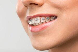 Fix buck teeth with braces - WeSmile Dental