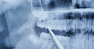 Wisdom tooth xray painless removal WeSmile Dental