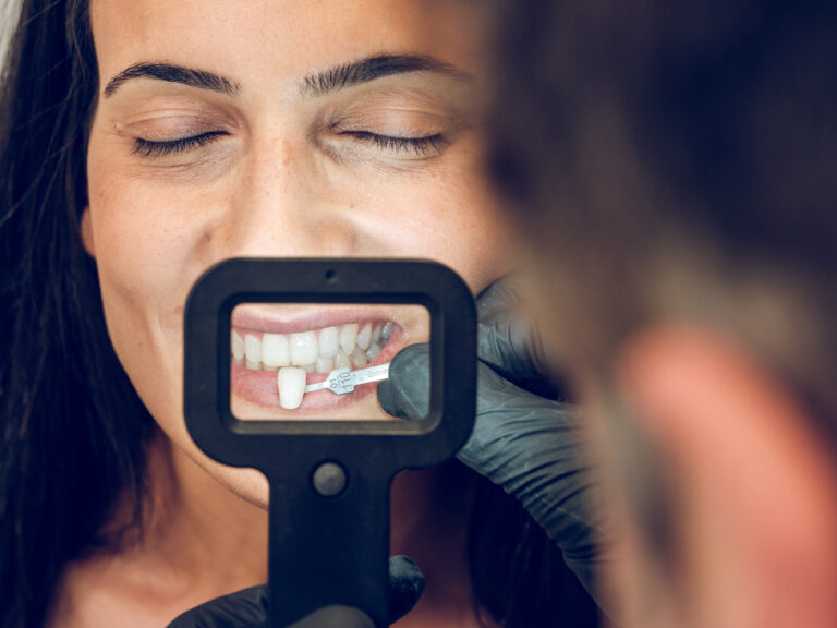 Veneers to fix buck teeth at WeSmile Dental