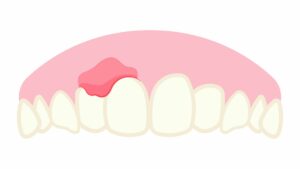 red and swollen gums - gum disease treatment 