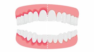 periodontitis - gum disease treatment 