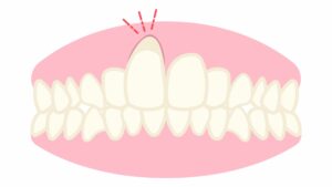 -receding gums - gum disease treatment 