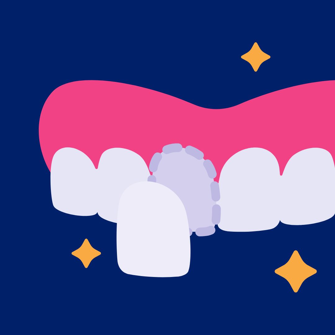 Teeth veneers in Singapore A gleaming smile makeover