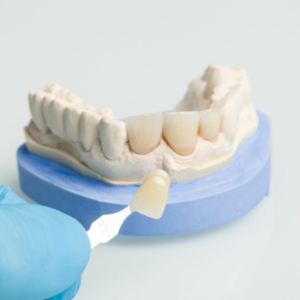 Teeth veneers in Singapore A gleaming smile makeover