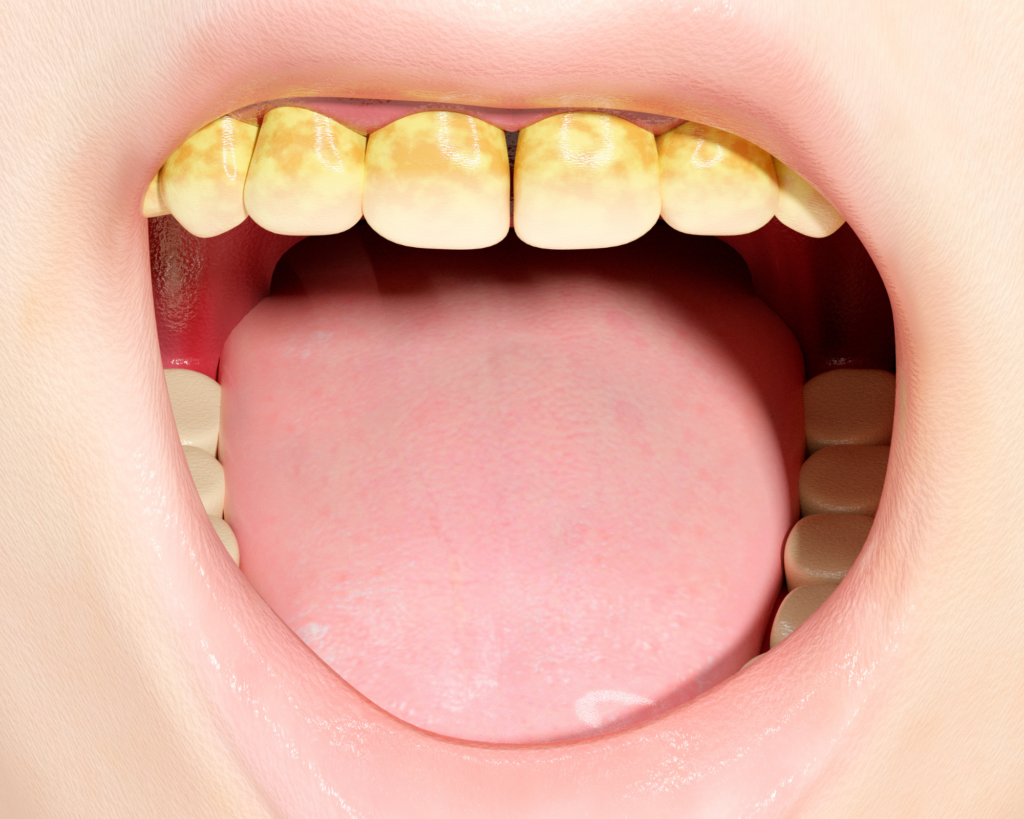 Tartar on teeth