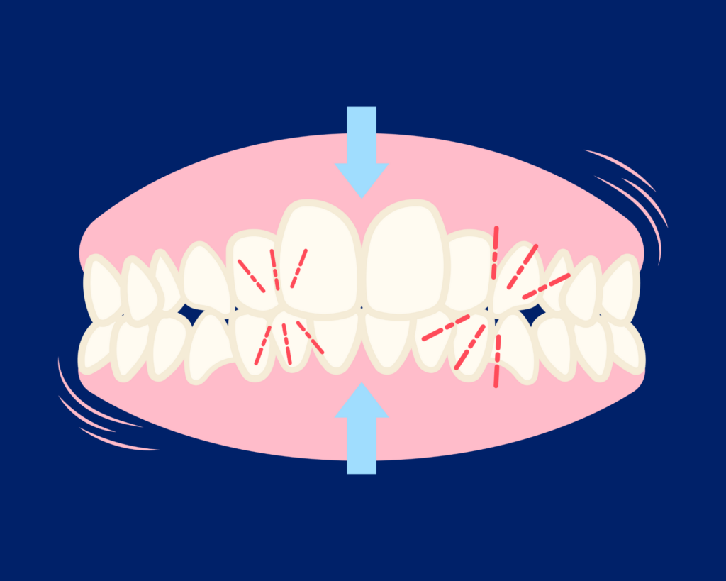 teeth grinding