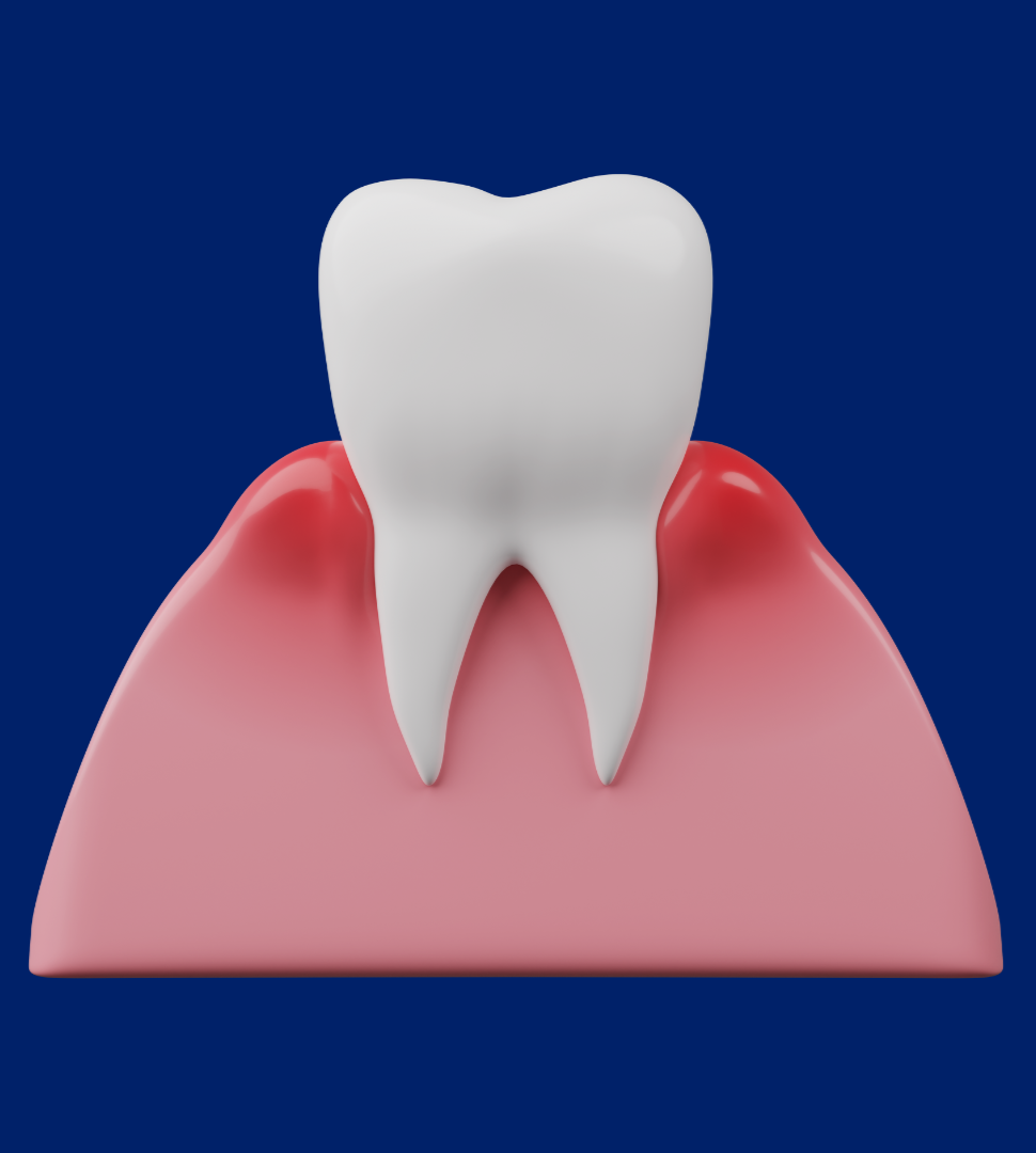 What is gingivitis & how to treat it?
