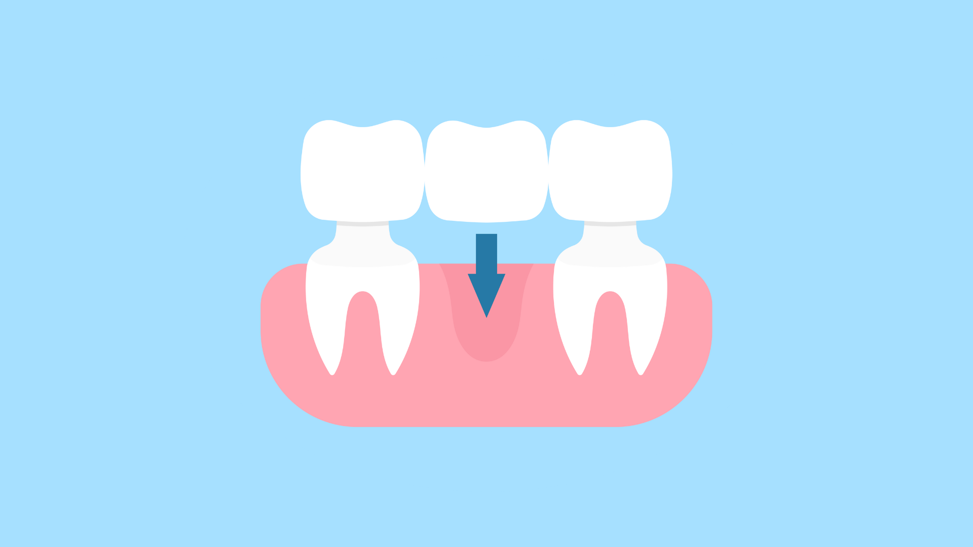 Dental bone grafts A comprehensive guide