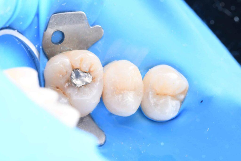 amalgam tooth fillings at WeSmile Dental Singapore