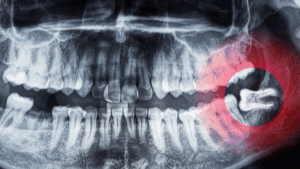 What Are Wisdom Teeth?