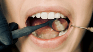 Will Everyone Get Wisdom Teeth?