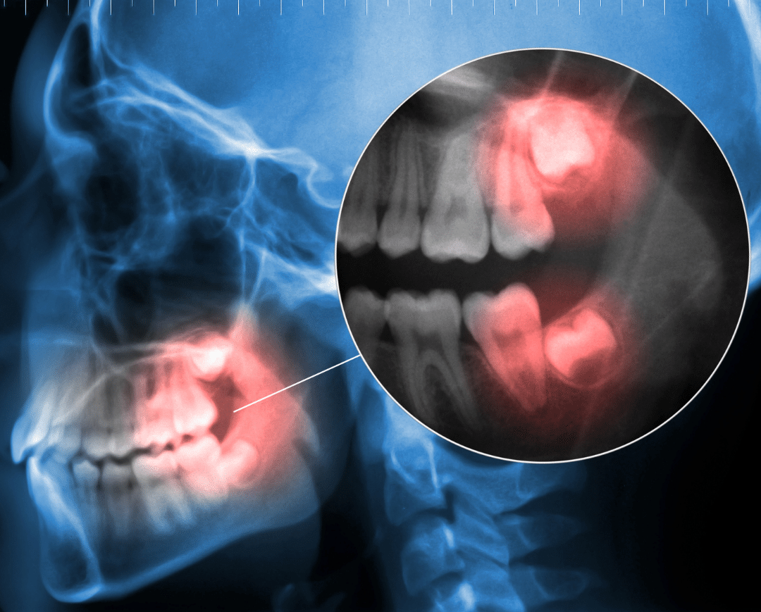 Impacted tooth extraction near me