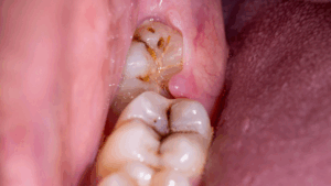 Challenges associated with Wisdom Teeth