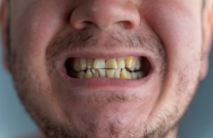 Teeth Stains