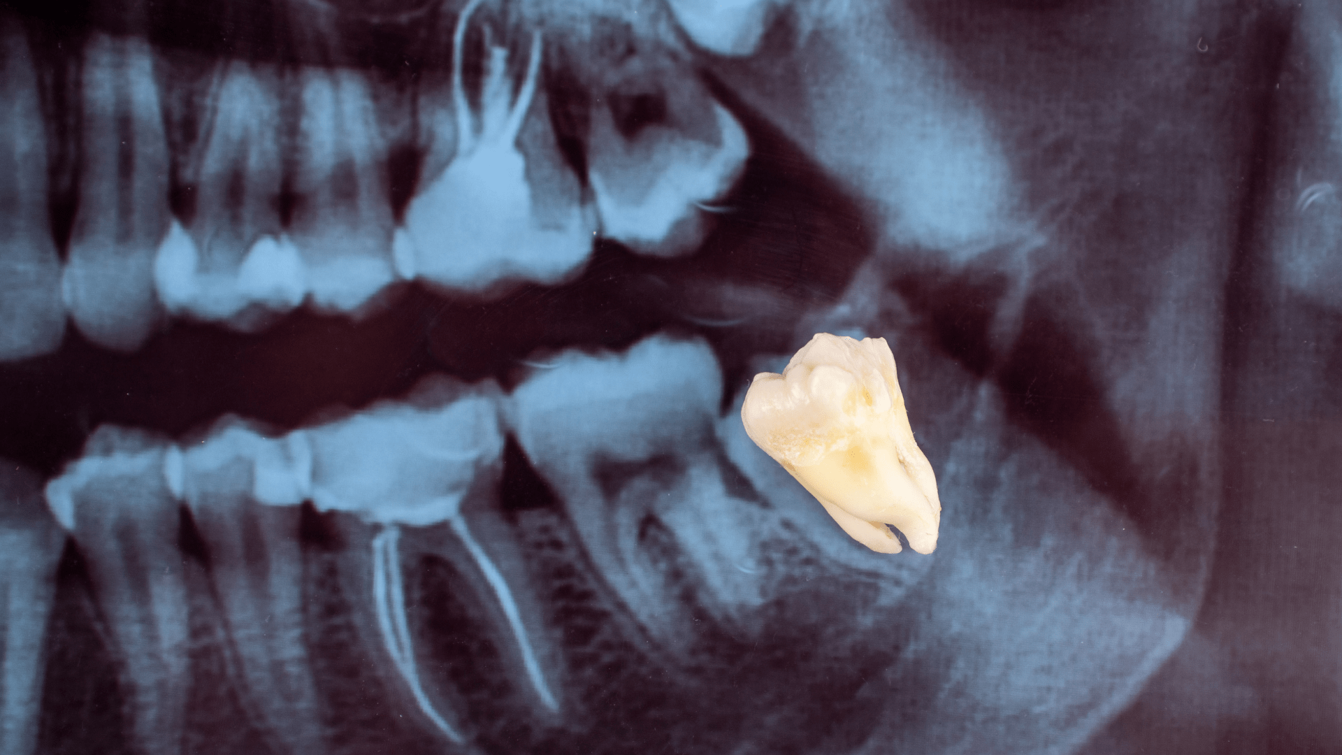 Wisdom Tooth Pain: What You Need to Know and How to Find Relief ...
