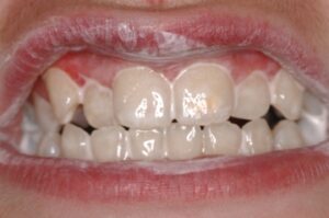Teeth Coated with Tooth Mousse