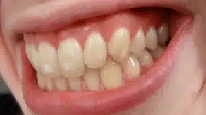 White Spots on Teeth
