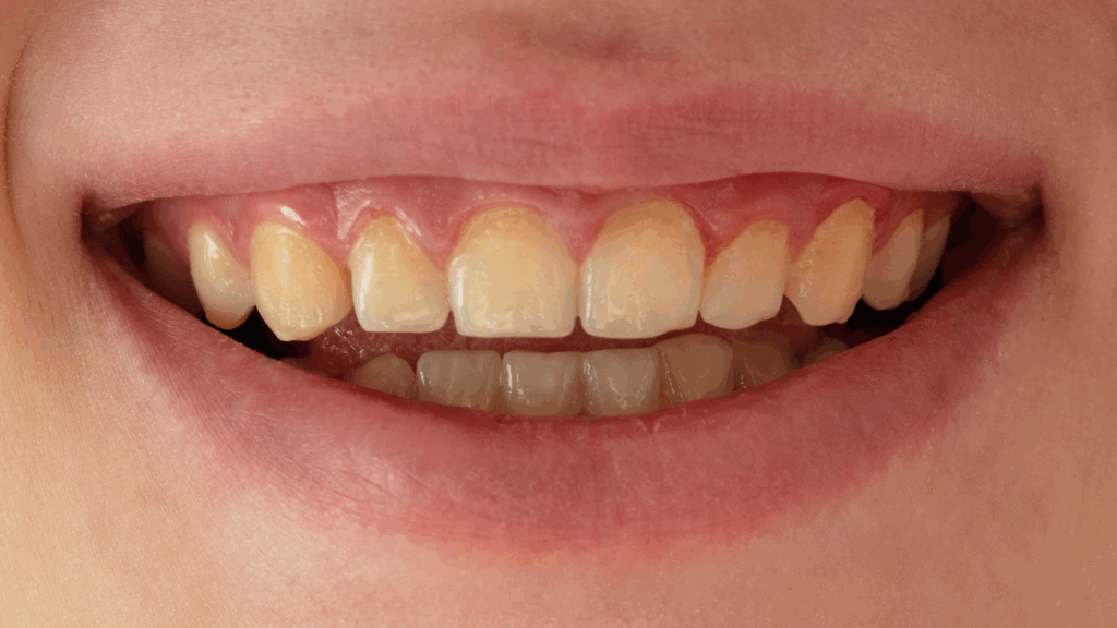 Veneers for Discoloured or stained teeth