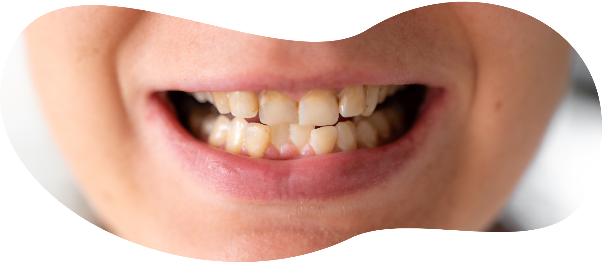 Crooked or uneven teeth
