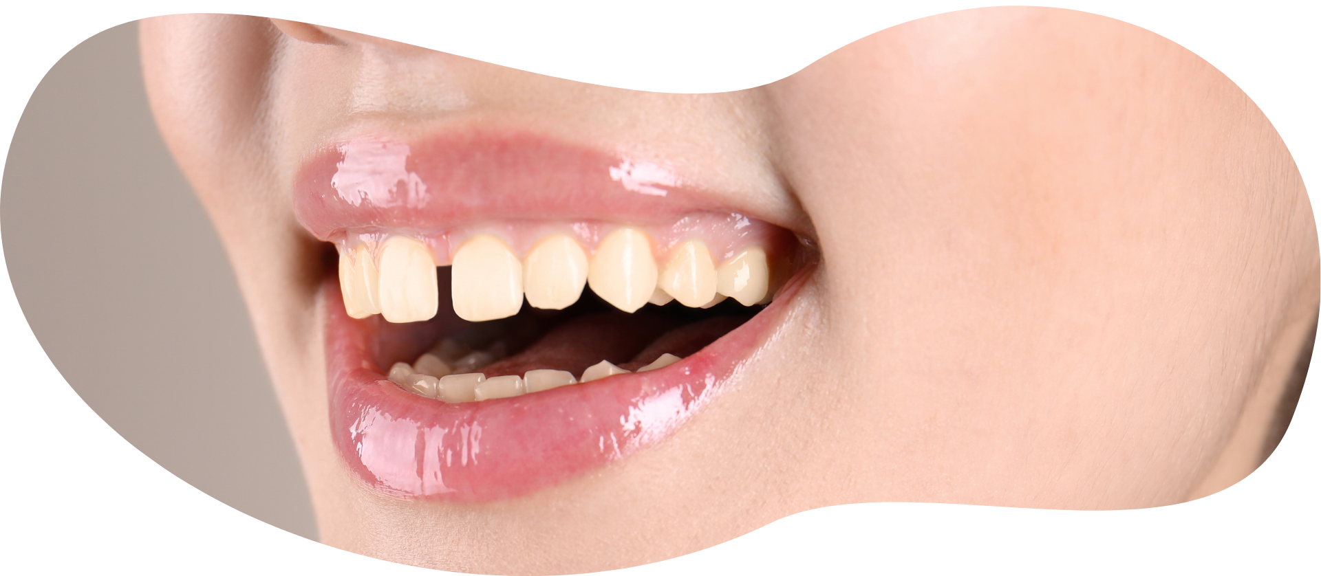 Gaps or missing teeth