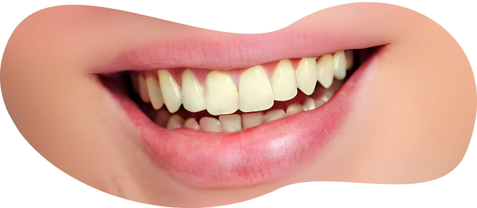 Uneven smile lines or lip symmetry
