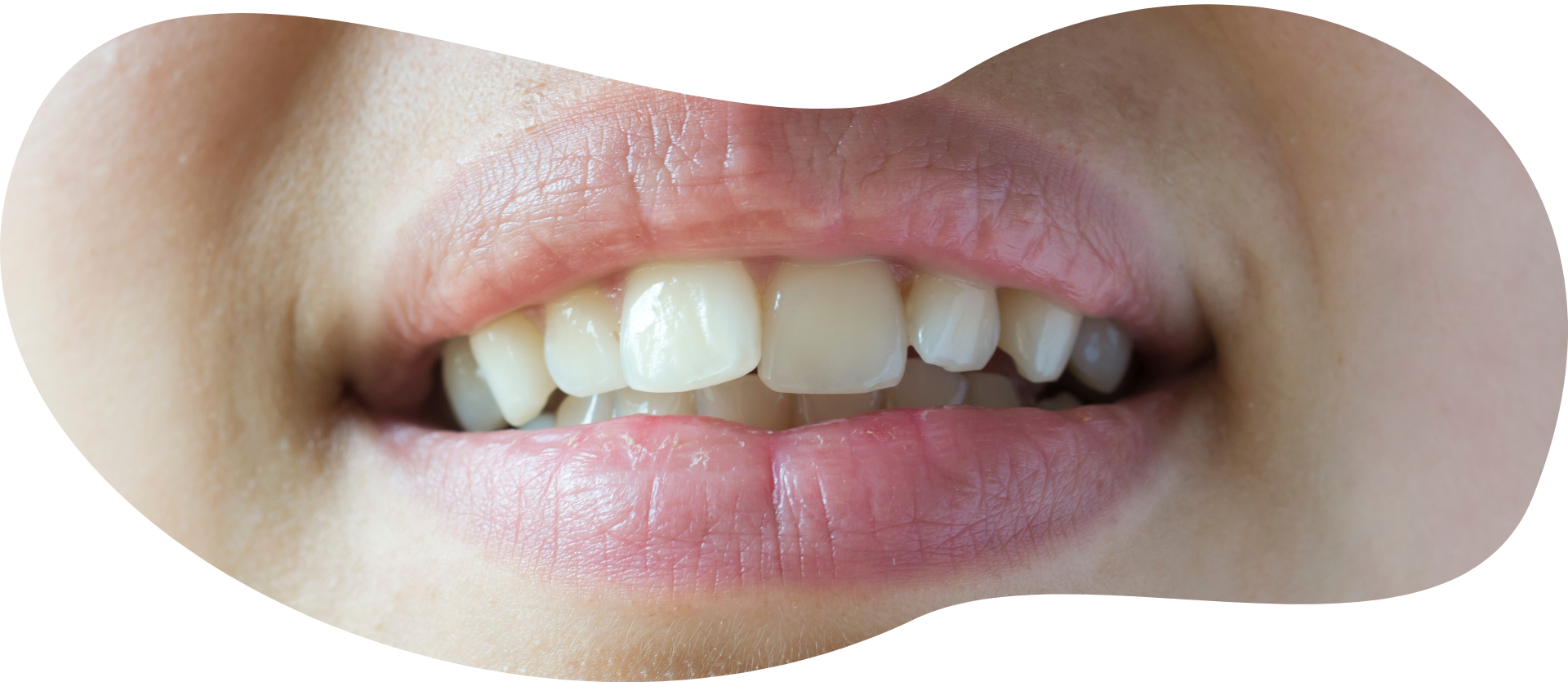 Overbite / Underbite