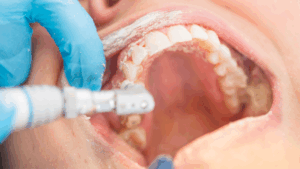 Teeth Whitening Procedure