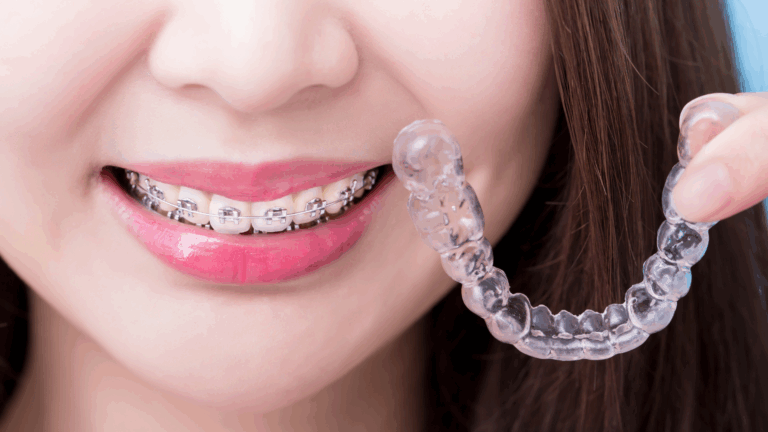 Invisalign vs Braces: Which Option Is Right for You?
