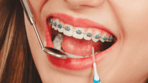 Woman with Traditional Braces