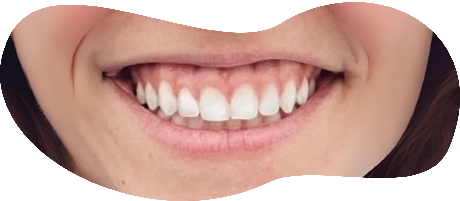 short teeth / gummy smile