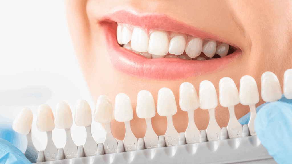 Take-Home Whitening Kits vs In-Clinic Teeth Whitening: What Works Best?
