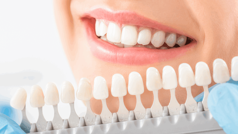 Take-Home Whitening Kits vs In-Clinic Teeth Whitening: What Works Best?
