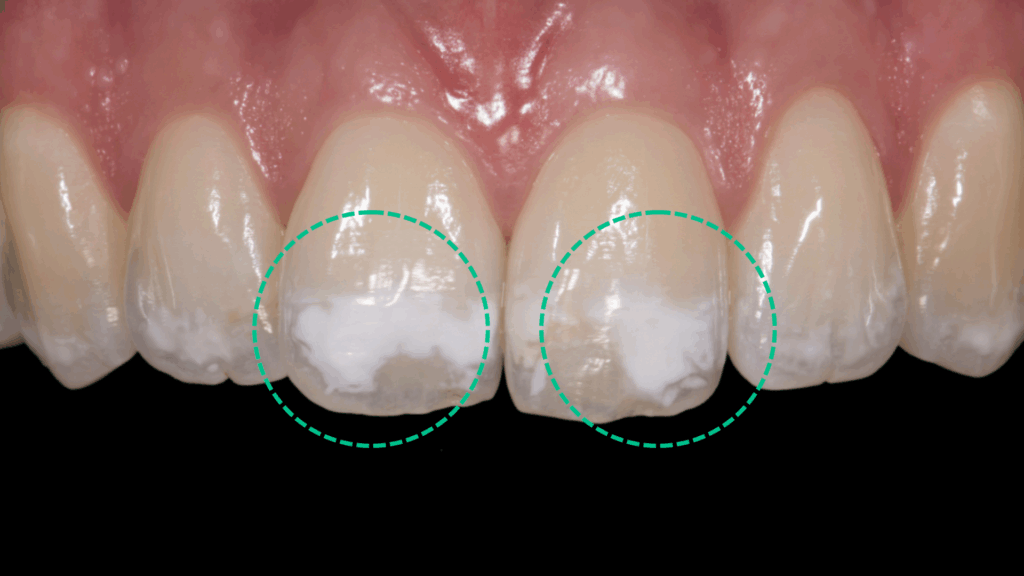 White Spots on Teeth