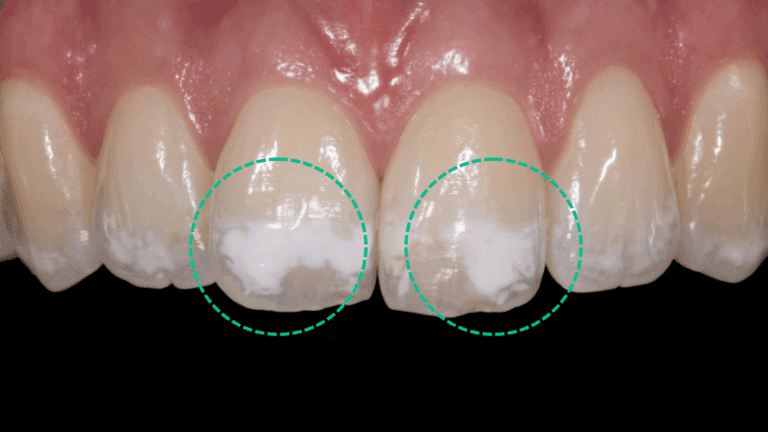 White Spots on Teeth
