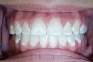White Spots on Teeth