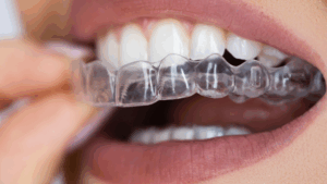 Invisalign vs Zenyum: Which Clear Aligner Is Right for You?