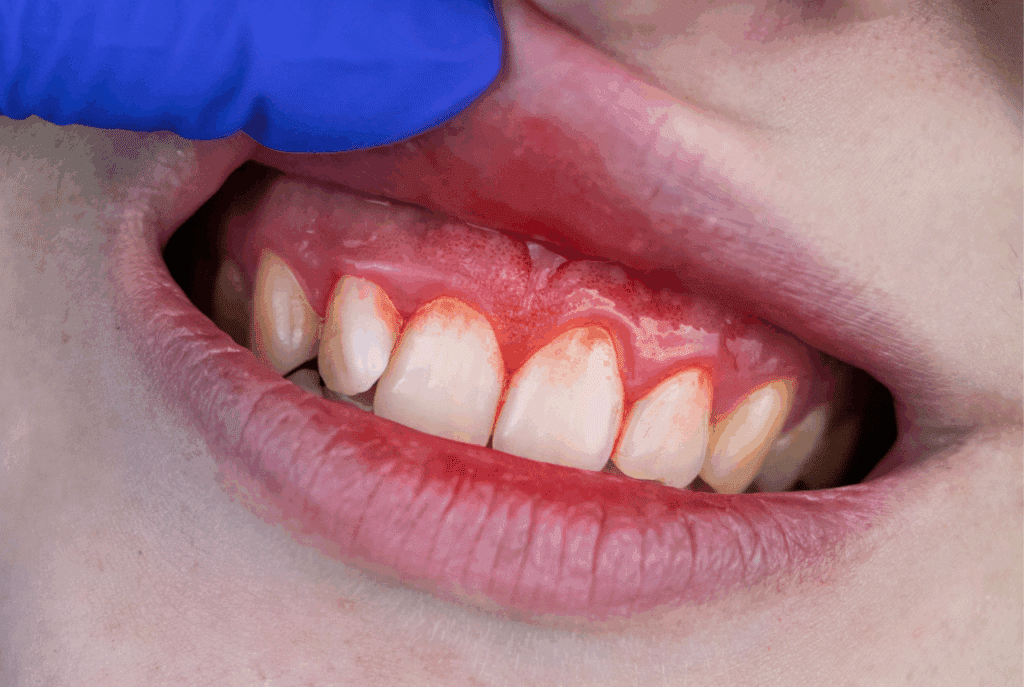 Periodontitis