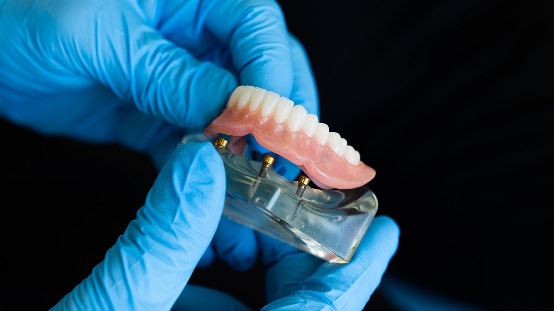Implant Overdenture & All-on-4s/All-on-6s