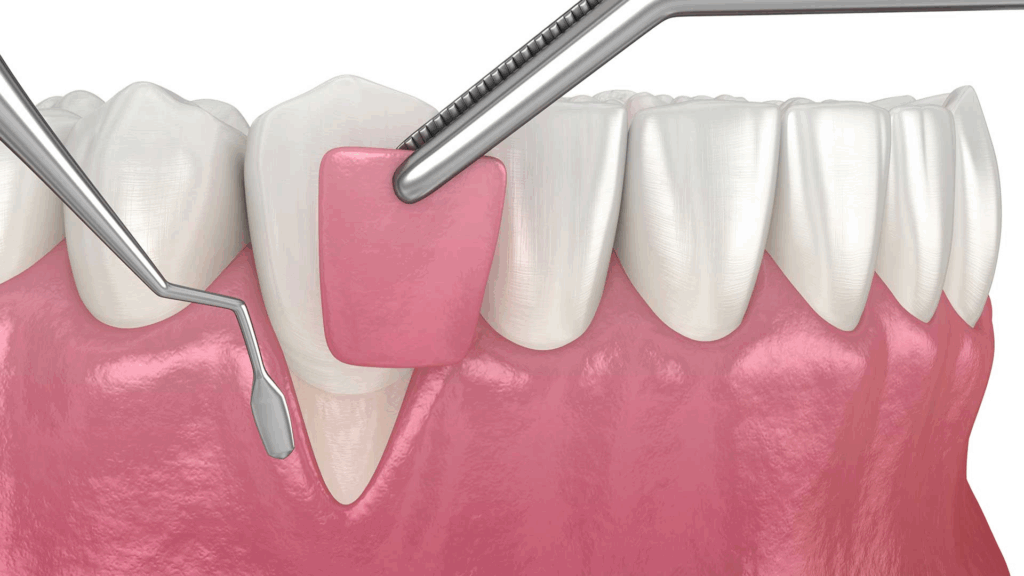 Soft Tissue Graft for Receding Gums