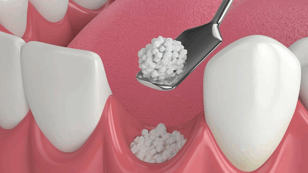 Bone Graft for Gum & Bone Loss