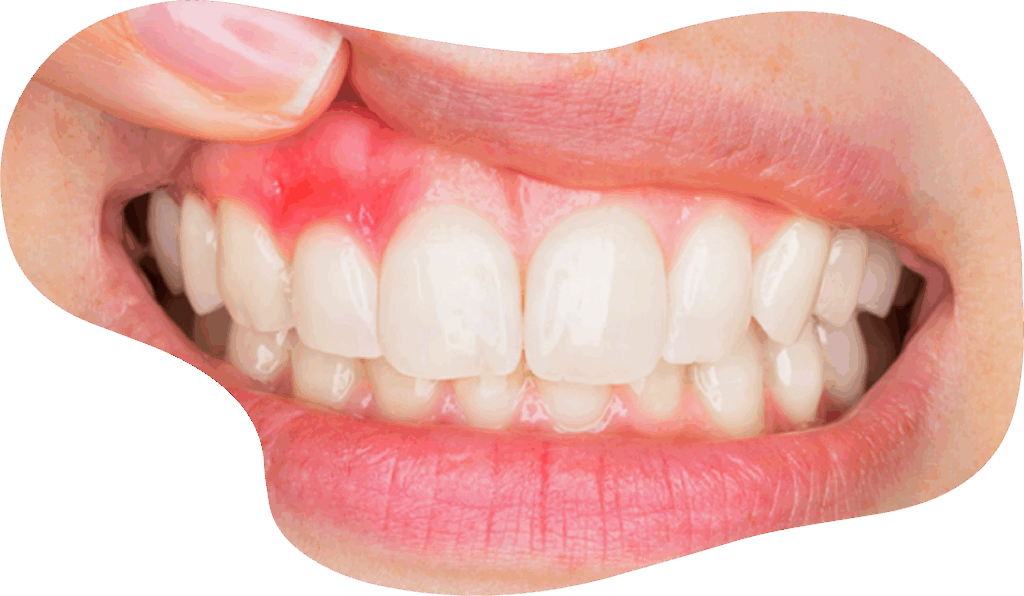 Gum Disease Treatment