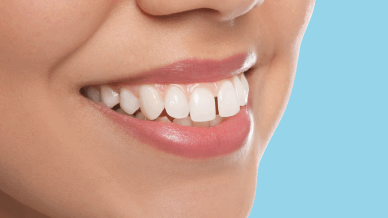 Gap Between Teeth: Why It Happens and How to Fix It