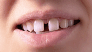 Gap Between Teeth (Diastema)