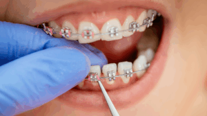 Braces for Gaps Between Teeth