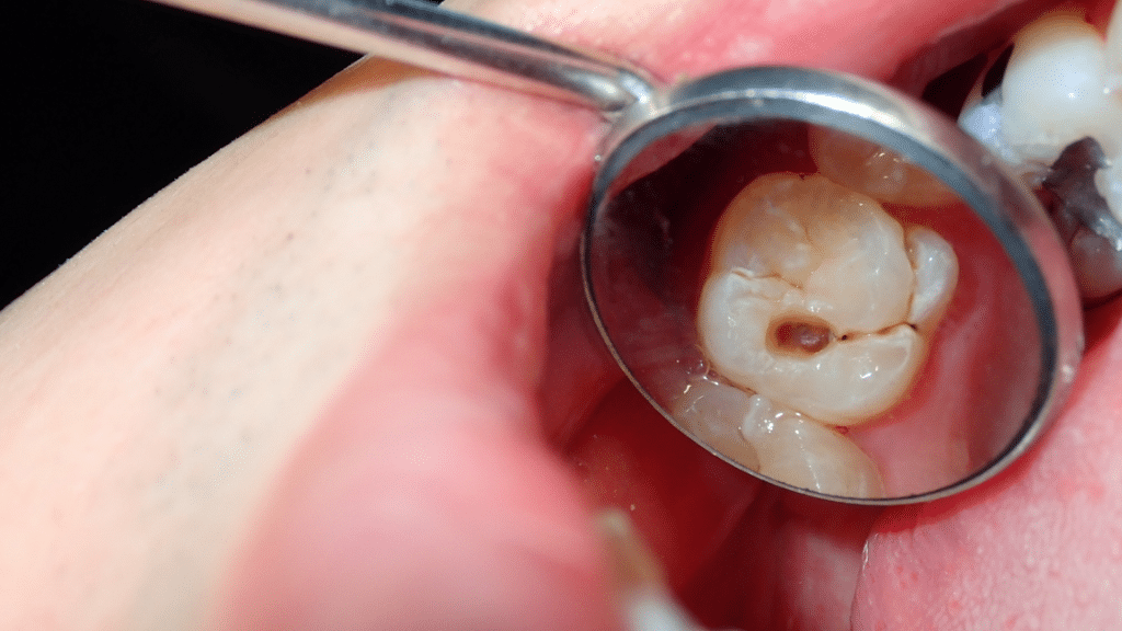 Untreated or deep tooth decay