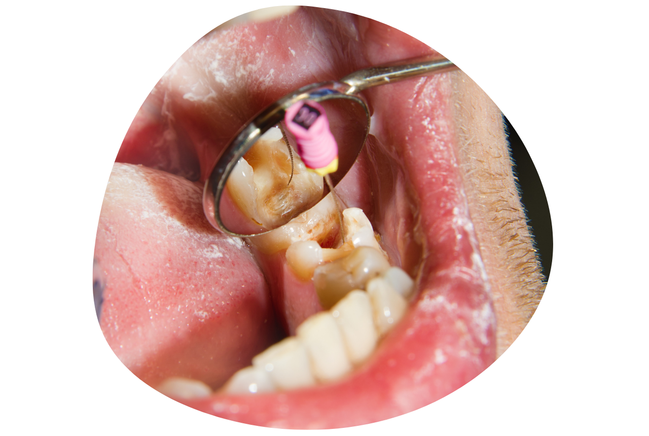 What is root canal treatment