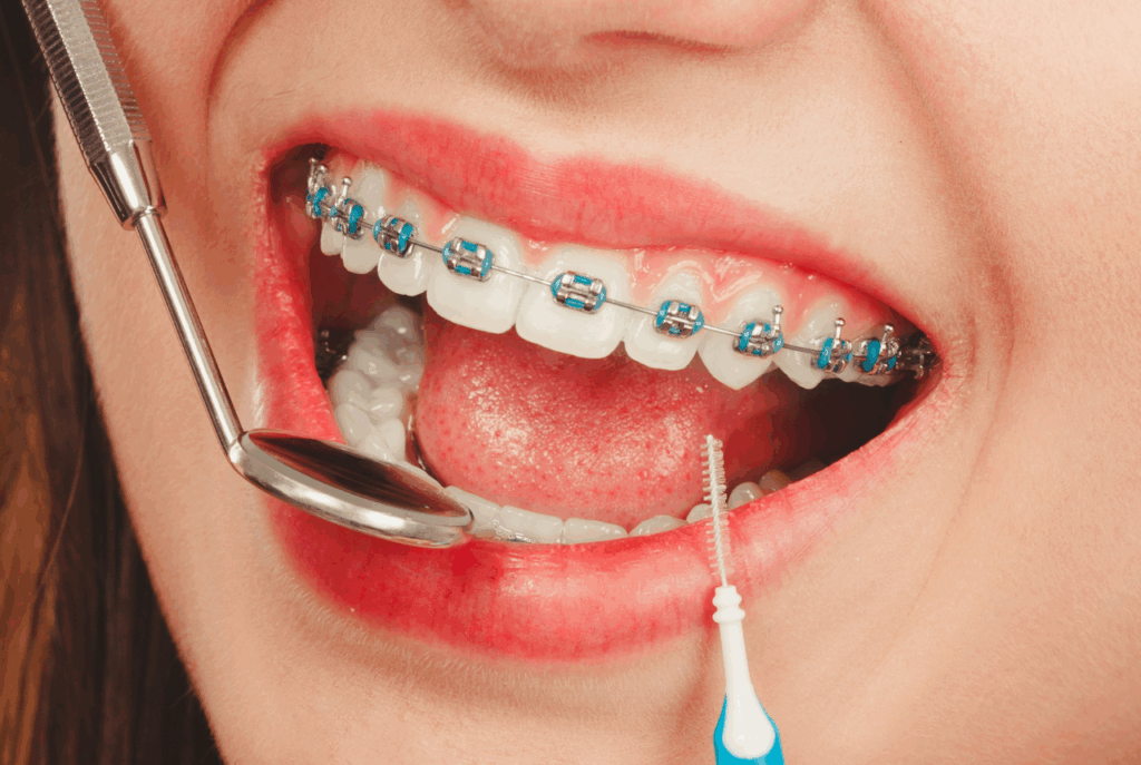 Cheap Metal braces in Singapore