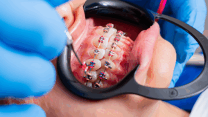 Cheapest Braces in Singapore for Students