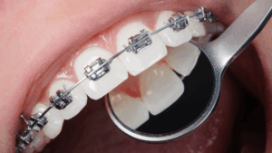 Braces in Singapore: What You Should Know